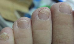 灰指甲用什么有效？知足抗菌足膜能根治